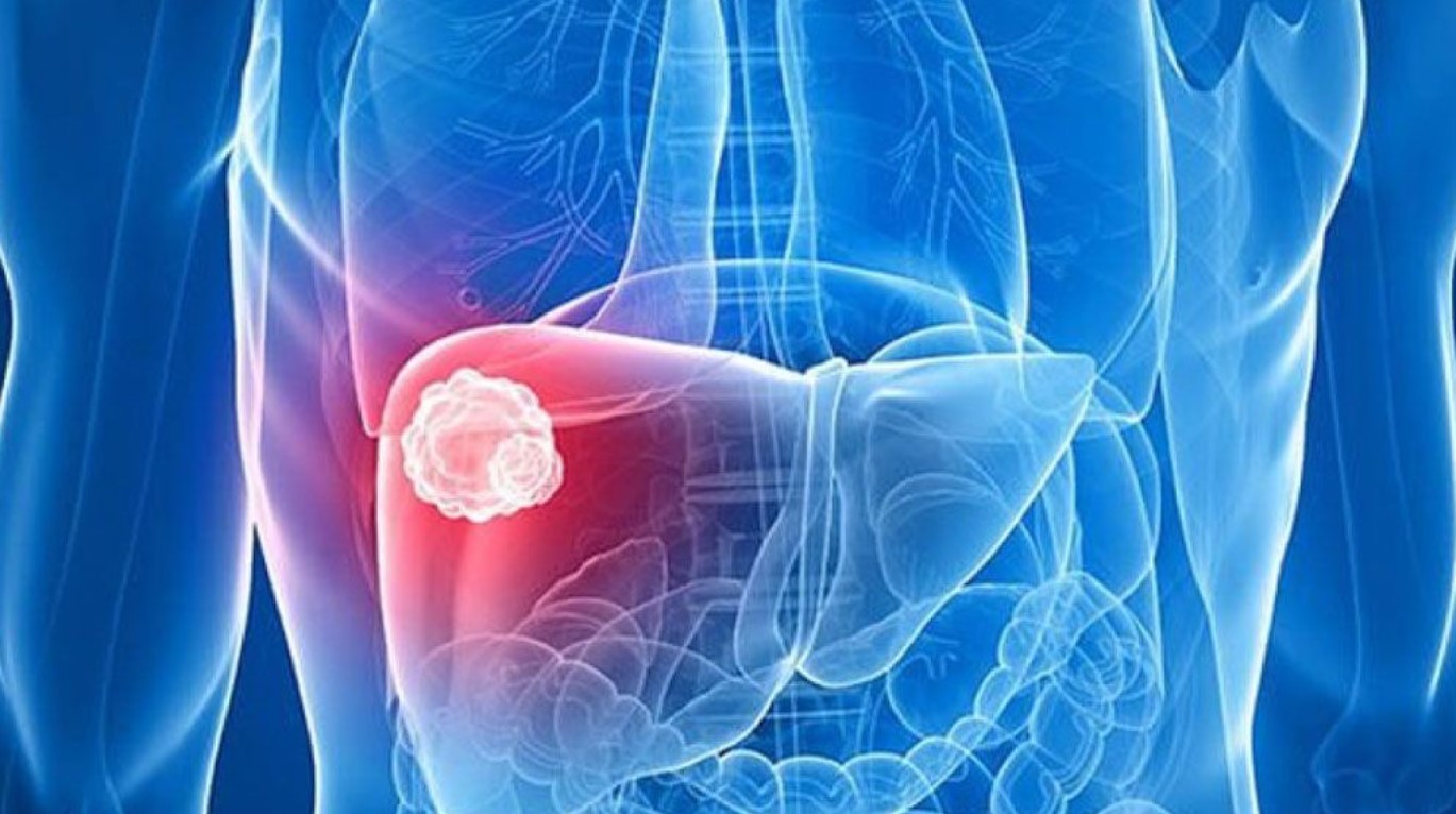 লিভার ক্যানসার প্রতিরোধ করতে ৬টি বিষয় মেনে চলতে হবে