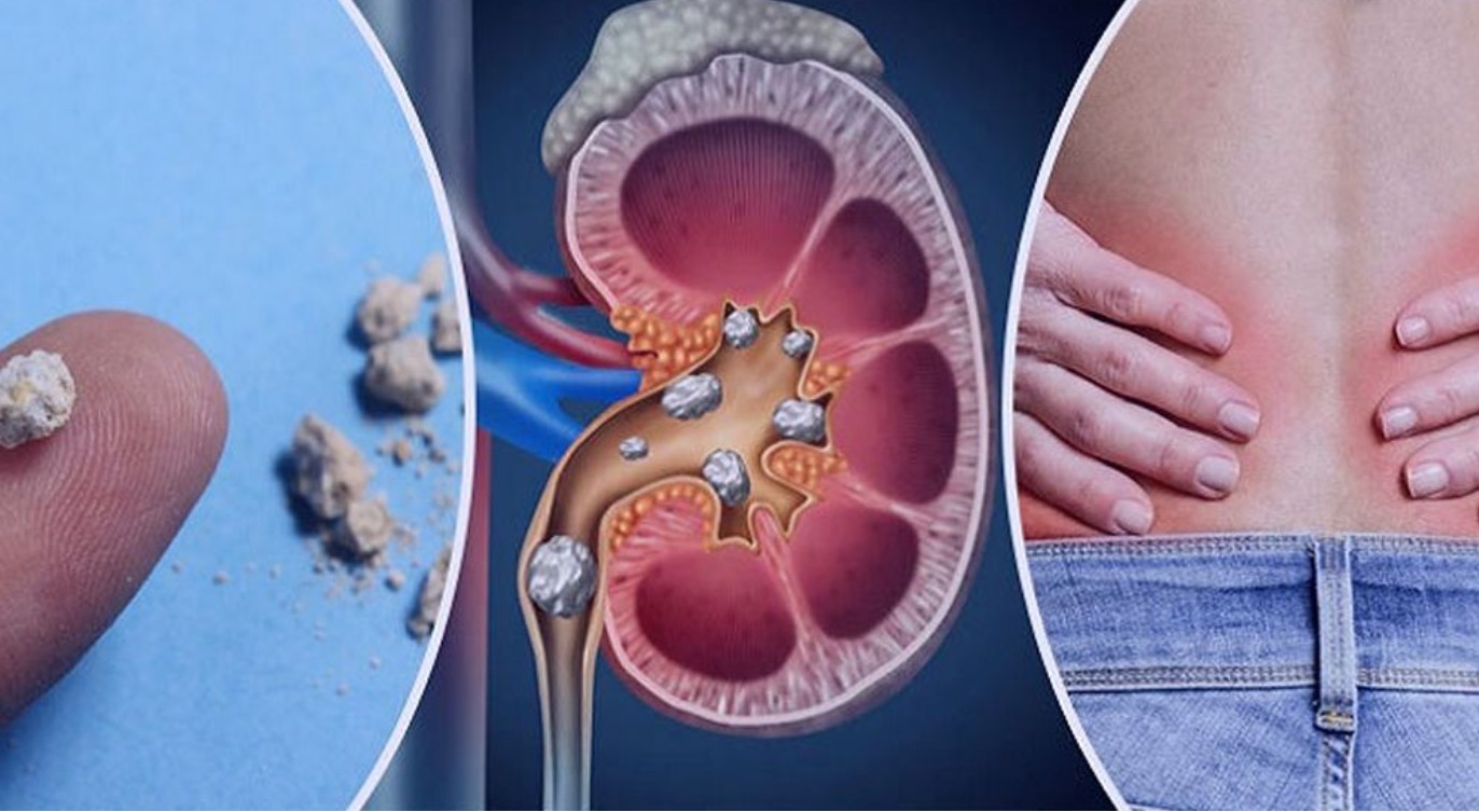 কিডনিতে পাথর হয়েছে কি-না বুঝবেন কিভাবে?